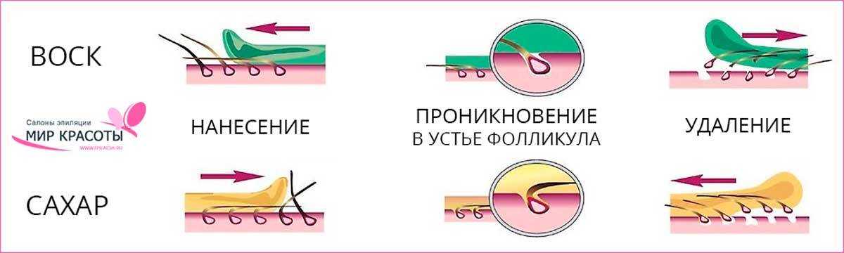 Все об эпиляторах и других способах удаления нежелательных волос